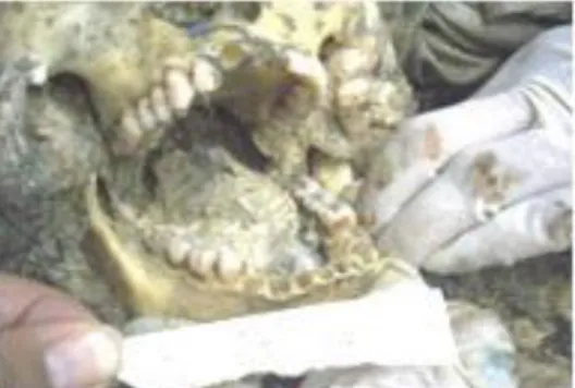 Gambar  16.    Pemeriksaan  Primer  Gigi  Tidak  Akurat  Akibat  Avulsi  Gigi  Postmortem dan Hilangnya Jaringan Lunak