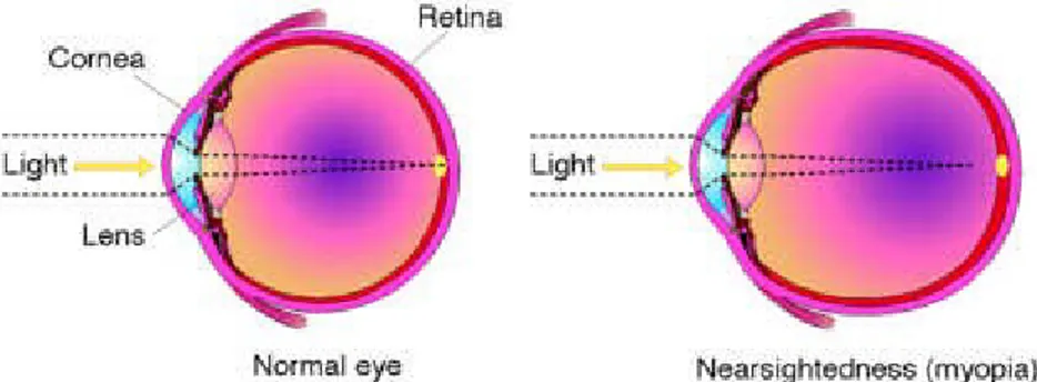 Gambar 2.1: Perbandingan skematis mata normal  dengan miopi 