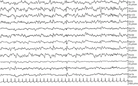 Gambar  5.  Hasil  elektroensefalografi  pada  pasien  uremic  encephalopathy,  didapatkan perlambatan general dengan gelombang delta dan theta dan spikes  bilateral 12 