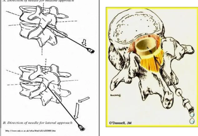Gambar 4. Tusukan Jarum pada Anestesi Spinal 