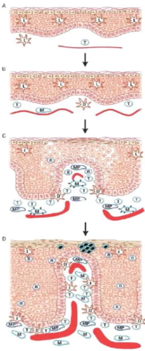 Gambar 1. Perkembangan lesi psoriasis. 1