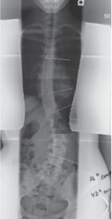 Gambar   10.  Proyeksi   dengan   posisi   PA   berdiri   memperlihatkan   2  kelengkungan tulang belakang : kelengkungan lumbal primer 42 o  dan lanjutan dari  kelengkungan 16 o  berlokasi pada superior kelengkungan primer