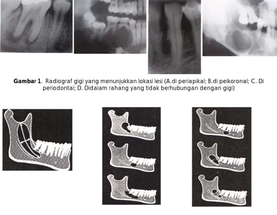 Gambar 2. A. Ilustrasi radiografik ukuran lesi; B. Ilustrasi radiografik lesion margin (outline of edge); B