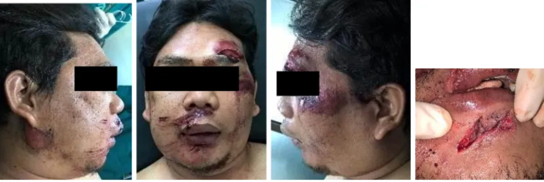 Gambar 1. Ekstra Oral tampak pembengkakan pada pipi kanan dan beberapa luka robek pada wajah    