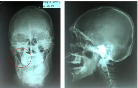 Gambar 5. Pada rontgen kepala kesan tampak beberapa garis fraktur pada daerah corpus   mandibula kanan sampai ke parasimfisis kiri 