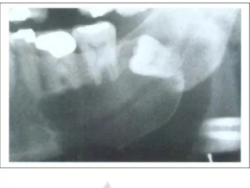 Gambar 2.5. Kista dentigeorus tipe lateral menunjukkan kista yang besar di sepanjang akar mesial  gigi impaksi.