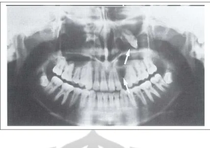 Gambar 2.8. Kista dentigerous menyebabkan pergeseran gigi kaninus ke dalam ruang maxilary  antrum serta menggeser insisif lateral dan premolar satu.