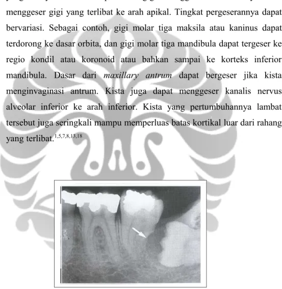 Gambar 2.10. Resorpsi akar distal gigi molar dua.
