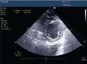 Gambar 3. Terlihat pemindain /tracing endokardial pada  akhir fase diastolik (pada keadaan dimana ventrikel paling  mengembang) untuk mendapatkan data mengenai status  volume berdasarkan kriteria area endokardial ventrikel