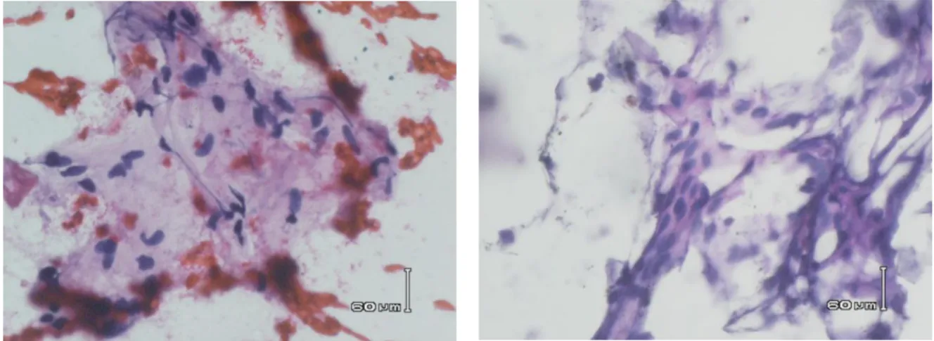 Gambar 3. Gambaran mikroskopik  dari hasil pemeriksaan biopsi aspirasi  jarum halus benjolan di  leher menunjukkan sel-sel yang berbentuk kumparan 