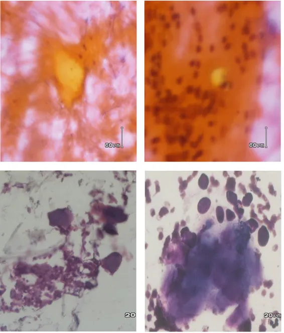 Gambar 4. Gambaran mikroskopik  dari hasil pemeriksaan biopsi aspirasi  jarum halus benjolan di  daerah  leher  menunjukkan  bahan  amorf  (amiloid)  berwarna  jingga  dengan  pengecatan  Papapanicolau (atas), dan merah magenta dengan pengecatan MGG (bawah