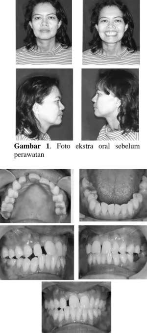 Gambar 2. gambar intra oral sebelum perawatan 