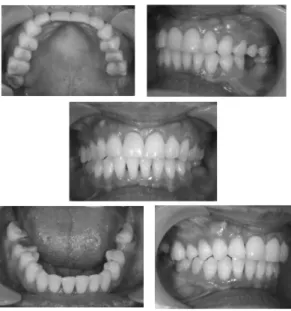 Gambar 4. Foto intra oral setelah debonding dan   reshaping gigi insisif lateral atas kiri dan kanan 