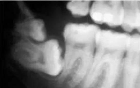 Gambar 1. Gigi Supernumerary Tipe Mesiodens di antara       Kedua Gigi Insisif Sentral Rahang Atas.