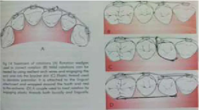 Gambar 9 (A) Rotation wedge yang digunakan untuk koreksi                    rotasi gigi insisif sentral kiri