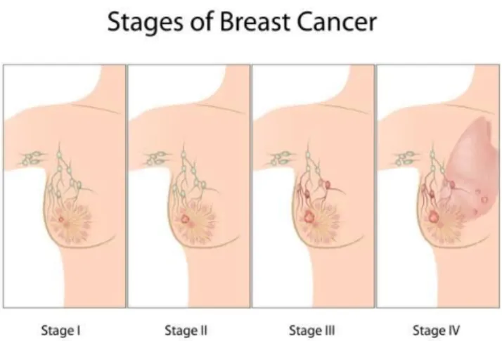 Gambar 4. Tahapan Perkembangan Kanker Payudara 