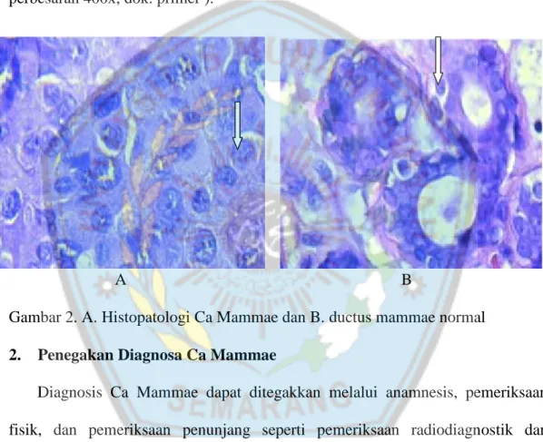 Gambar 2. A. Histopatologi Ca Mammae dan B. ductus mammae normal 2. Penegakan Diagnosa Ca Mammae