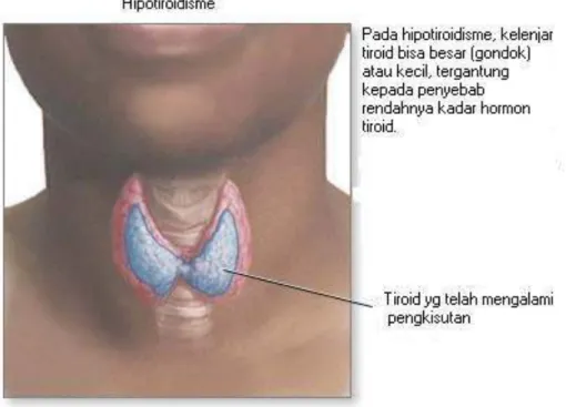 Gambar 2.10. Hipotiroidisme  39 