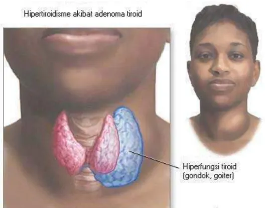 Gambar 2.11. Hipertiroidisme 39 