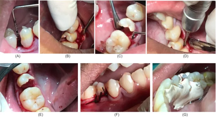 Gambar 2.  (A) Pengukuran kedalaman dasar kavitas dan bone sounding dengan probe periodontal; (B) Diseksi dengan raspatorium; 