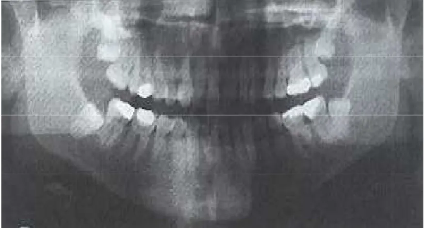 Gambar  II.4  Impaksi  mesioangular  molar  ketiga  rahang  bawah  kanan  dan  distoangular  pada  molar  ketiga  rahang  bawah  kiri    (catatan:  gigi  molar ketiga rahang bawah tidak erupsi) 