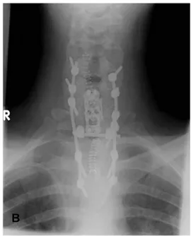 Foto polos dari vertebra tidak banyak membantu  pada kasus limfoma primer pada tulang vertebra, dan  tidak dapat membedakan apakah lesinya berasal dari  proses primer ataukah sekunder metastasis