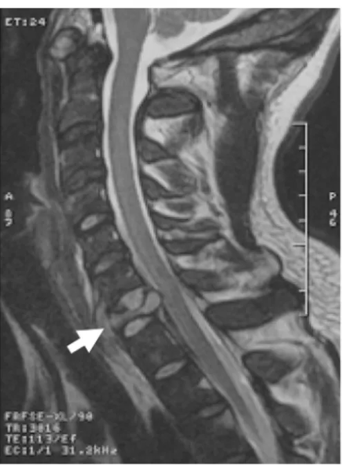 Gambar 2. Sekuens T2W MRI potongan sagital menunjukkan  suatu massa hiperintens yang mendestruksi dan menggantikan  korpus vertebra C7 disertai kompresi pada korda spinalis pada  ruang epidural.