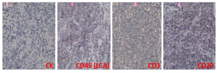 Gambar 4. Pemeriksaan patologikal non-imunohistokimia  awal menunjukkan pola yang serupa dari karsinoma sel  skuamosa  undifferentiated dengan limfoma