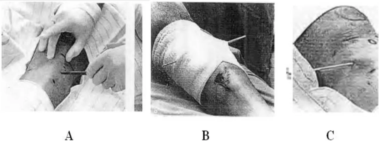 Gambar 9.  (a) Titik masuk dari pin adalah 2 cm dibawah dan dibelakang dari tibial tuberosity