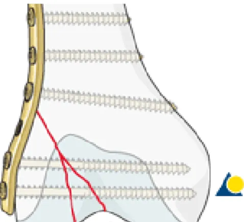 Gambar 11.  Plat yang dipasang pada permukaan lateral femur 