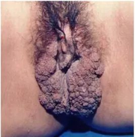 Gambar 3. Veruka Vulgaris 