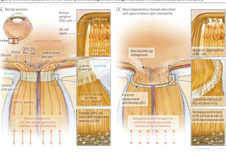 Gambar 5. Perubahan anatomi dan neurodegeneratif terkait neuropati optik glaukomatosa  3