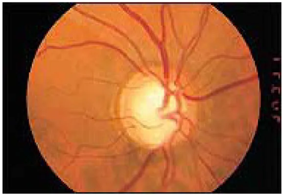 Gambar 10. Contoh gambaran funduskopi pada retina pasien glaukoma. Terdapat ekskavasio glaukomatosa dengan CD ratio 0.8 11