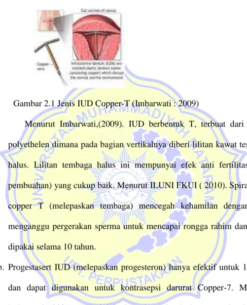Gambar 2.1 Jenis IUD Copper-T (Imbarwati : 2009)  