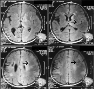 Gambar  1.  CT  scan  kepala  dengan  kontras  menunjukkan  area  infark  di  daerah  yang  disuplai  oleh cabang arteri serebri media (panah putih).