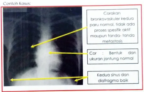 Foto thorax normal memberikan gambaran :  1.  Paru radiolusen 