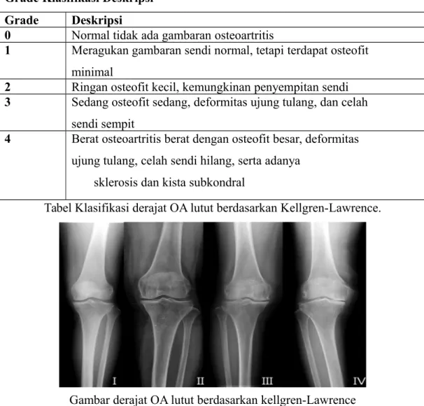 Tabel Klasifikasi derajat OA lutut berdasarkan Kellgren-Lawrence.