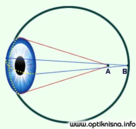 Gambar 3. Astigmatisme Miopia Simpleks