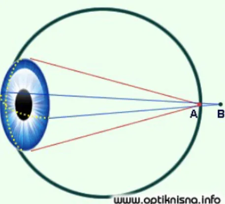 Gambar 4. Astigmatisme Hiperopia Simpleks