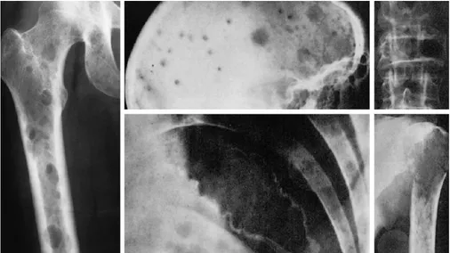 Gambar 7. Karakteristik X-Ray penipisan  tulang, fraktur kompresi vertebra, memperluas lesi (biasanya di tulang rusuk dan panggul) dan daerah punched-out di