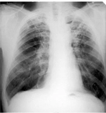 Gambar 7. Rontgen Toraks Tuberkulosis Paru 