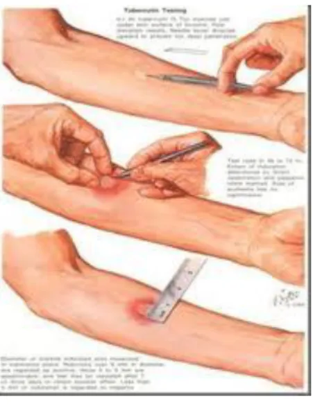 Gambar 8. Tes Tuberkulin Intradermal (Mantoux) 12 