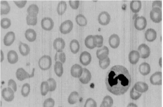 Gambar  2.    Hapusan  darah  tepi  pada  anemia  defisiensi  besi.  Tampak hipokromik mikrositik, anisositosis dan poikilositosis.