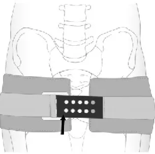 Gambar 4. Ilustrasi yang mendemonstrasikan aplikasi alat kompresi melingkar pelvis (pengikat pelvis)  yang tepat, dengan gesper tambahan (tanda panah) untuk mengontrol tekanan