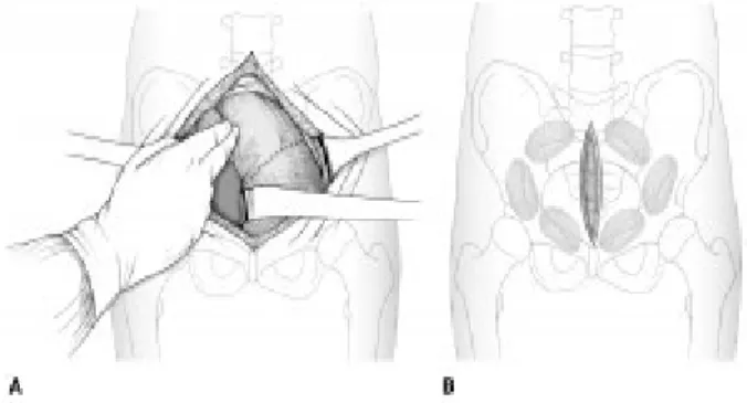 Gambar 5. Ilustrasi yang mendemonstrasikan teknis pembalutan retroperitoneal. A, dibuat sebuah insisi  vertikal midline 8-cm