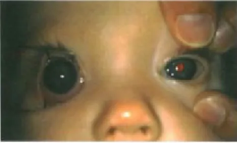 Gambar 9: primary congenital glaucoma, mata kanan. Pembesaran kornea.