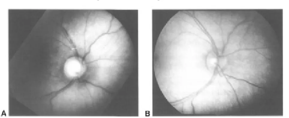 Gambar 11: A. pembesaran optic disc cup preoperative B. penurunan dlaam disc cupping setelah tekanan intraocular diturunkan dengan goniotomi.