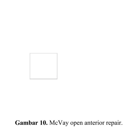 Gambar 10. McVay open anterior repair.