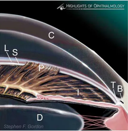 Gambar 2. Glaukoma sekunder sudut terbuka akibat uveitis anterior 