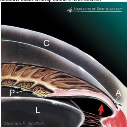 Gambar 3. Glaukoma sekunder sudut tertutup akibat uveitis anterior